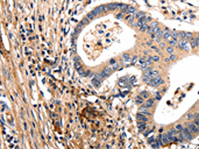 The image on the left is immunohistochemistry of paraffin-embedded Human colon cancer tissue using CSB-PA932427(GSK3A Antibody) at dilution 1/50, on the right is treated with synthetic peptide. (Original magnification: ×200)