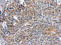 The image on the left is immunohistochemistry of paraffin-embedded Human esophagus cancer tissue using CSB-PA932598(ITGAL Antibody) at dilution 1/20, on the right is treated with synthetic peptide. (Original magnification: ×200)