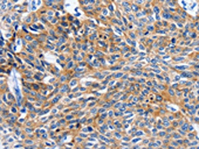 The image on the left is immunohistochemistry of paraffin-embedded Human esophagus cancer tissue using CSB-PA932598(ITGAL Antibody) at dilution 1/20, on the right is treated with synthetic peptide. (Original magnification: ×200)