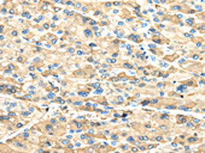 The image on the left is immunohistochemistry of paraffin-embedded Human liver cancer tissue using CSB-PA932977(INHBB Antibody) at dilution 1/40, on the right is treated with synthetic peptide. (Original magnification: ×200)