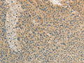 The image on the left is immunohistochemistry of paraffin-embedded Human liver cancer tissue using CSB-PA933359(TEKT3 Antibody) at dilution 1/20, on the right is treated with fusion protein. (Original magnification: ×200)