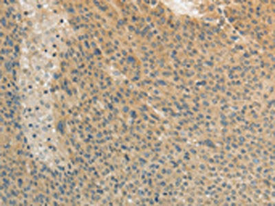 The image on the left is immunohistochemistry of paraffin-embedded Human liver cancer tissue using CSB-PA933359(TEKT3 Antibody) at dilution 1/20, on the right is treated with fusion protein. (Original magnification: ×200)