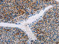 The image on the left is immunohistochemistry of paraffin-embedded Human liver cancer tissue using CSB-PA933658(APOBEC4 Antibody) at dilution 1/20, on the right is treated with fusion protein. (Original magnification: ×200)