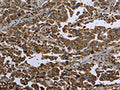 The image on the left is immunohistochemistry of paraffin-embedded Human liver cancer tissue using CSB-PA933674(HSPA9 Antibody) at dilution 1/50, on the right is treated with fusion protein. (Original magnification: ×200)