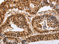 The image on the left is immunohistochemistry of paraffin-embedded Human colon cancer tissue using CSB-PA933880(PSMD8 Antibody) at dilution 1/25, on the right is treated with fusion protein. (Original magnification: ×200)
