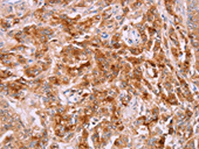 The image on the left is immunohistochemistry of paraffin-embedded Human prostate cancer tissue using CSB-PA933890(LPCAT4 Antibody) at dilution 1/15, on the right is treated with synthetic peptide. (Original magnification: ×200)