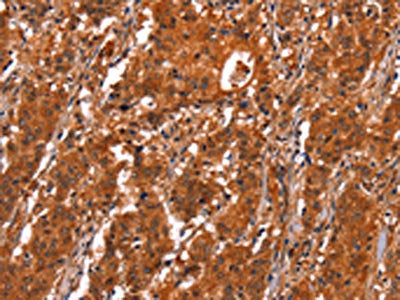 The image on the left is immunohistochemistry of paraffin-embedded Human gastic cancer tissue using CSB-PA934012(GCG Antibody) at dilution 1/20, on the right is treated with synthetic peptide. (Original magnification: ×200)