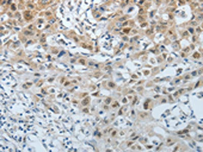 The image on the left is immunohistochemistry of paraffin-embedded Human lung cancer tissue using CSB-PA934176(CDKN1A Antibody) at dilution 1/15, on the right is treated with fusion protein. (Original magnification: ×200)