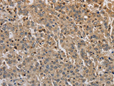 The image on the left is immunohistochemistry of paraffin-embedded Human liver cancer tissue using CSB-PA934409(ADO Antibody) at dilution 1/30, on the right is treated with synthetic peptide. (Original magnification: ×200)