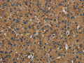 The image on the left is immunohistochemistry of paraffin-embedded Human liver cancer tissue using CSB-PA934669(GBP5 Antibody) at dilution 1/50, on the right is treated with fusion protein. (Original magnification: ×200)