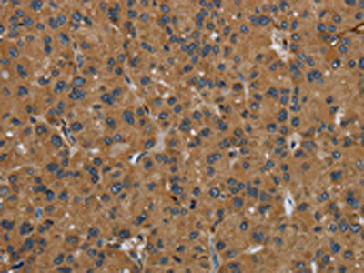 The image on the left is immunohistochemistry of paraffin-embedded Human liver cancer tissue using CSB-PA934669(GBP5 Antibody) at dilution 1/50, on the right is treated with fusion protein. (Original magnification: ×200)