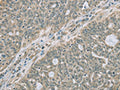 The image on the left is immunohistochemistry of paraffin-embedded Human ovarian cancer tissue using CSB-PA934707(RNASE3 Antibody) at dilution 1/20, on the right is treated with fusion protein. (Original magnification: ×200)