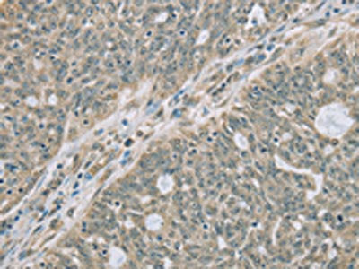 The image on the left is immunohistochemistry of paraffin-embedded Human ovarian cancer tissue using CSB-PA934707(RNASE3 Antibody) at dilution 1/20, on the right is treated with fusion protein. (Original magnification: ×200)