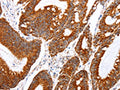The image on the left is immunohistochemistry of paraffin-embedded Human colon cancer tissue using CSB-PA934815(TNFAIP1 Antibody) at dilution 1/25, on the right is treated with fusion protein. (Original magnification: ×200)