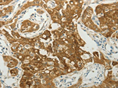 The image on the left is immunohistochemistry of paraffin-embedded Human lung cancer tissue using CSB-PA934831(MC4R Antibody) at dilution 1/30, on the right is treated with synthetic peptide. (Original magnification: ×200)