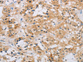 The image on the left is immunohistochemistry of paraffin-embedded Human thyroid cancer tissue using CSB-PA935079(RAD54L2 Antibody) at dilution 1/60, on the right is treated with fusion protein. (Original magnification: ×200)