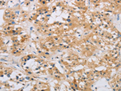 The image on the left is immunohistochemistry of paraffin-embedded Human thyroid cancer tissue using CSB-PA935079(RAD54L2 Antibody) at dilution 1/60, on the right is treated with fusion protein. (Original magnification: ×200)