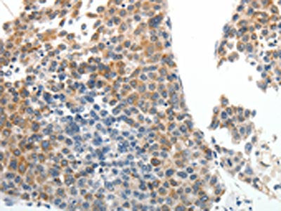 The image on the left is immunohistochemistry of paraffin-embedded Human liver cancer tissue using CSB-PA935474(ABCG5 Antibody) at dilution 1/20, on the right is treated with synthetic peptide. (Original magnification: ×200)