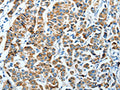 The image on the left is immunohistochemistry of paraffin-embedded Human breast cancer tissue using CSB-PA935612(ALDH4A1 Antibody) at dilution 1/45, on the right is treated with fusion protein. (Original magnification: ×200)