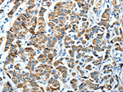 The image on the left is immunohistochemistry of paraffin-embedded Human breast cancer tissue using CSB-PA935612(ALDH4A1 Antibody) at dilution 1/45, on the right is treated with fusion protein. (Original magnification: ×200)