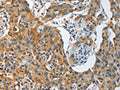 The image on the left is immunohistochemistry of paraffin-embedded Human lung cancer tissue using CSB-PA935662(TNFSF13 Antibody) at dilution 1/30, on the right is treated with fusion protein. (Original magnification: ×200)