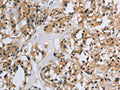 The image on the left is immunohistochemistry of paraffin-embedded Human thyroid cancer tissue using CSB-PA935849(IL5RA Antibody) at dilution 1/40, on the right is treated with synthetic peptide. (Original magnification: ×200)