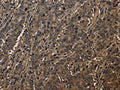 The image on the left is immunohistochemistry of paraffin-embedded Human liver cancer tissue using CSB-PA935864(GSTO1 Antibody) at dilution 1/60, on the right is treated with fusion protein. (Original magnification: ×200)