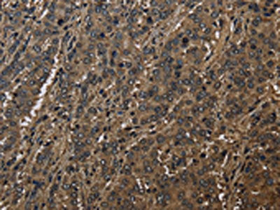 The image on the left is immunohistochemistry of paraffin-embedded Human liver cancer tissue using CSB-PA935864(GSTO1 Antibody) at dilution 1/60, on the right is treated with fusion protein. (Original magnification: ×200)