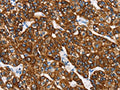 The image is immunohistochemistry of paraffin-embedded Human liver cancer tissue using CSB-PA935926(KRT8 Antibody) at dilution 1/40. (Original magnification: ×200)