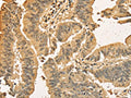 The image on the left is immunohistochemistry of paraffin-embedded Human colon cancer tissue using CSB-PA936102(CDCA8 Antibody) at dilution 1/40, on the right is treated with fusion protein. (Original magnification: ×200)