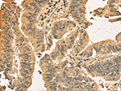 The image on the left is immunohistochemistry of paraffin-embedded Human colon cancer tissue using CSB-PA936102(CDCA8 Antibody) at dilution 1/40, on the right is treated with fusion protein. (Original magnification: ×200)