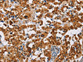 The image on the left is immunohistochemistry of paraffin-embedded Human thyroid cancer tissue using CSB-PA936340(ATXN1 Antibody) at dilution 1/40, on the right is treated with fusion protein. (Original magnification: ×200)