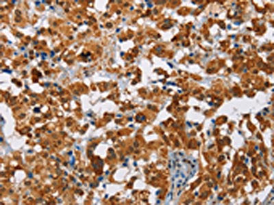 The image on the left is immunohistochemistry of paraffin-embedded Human thyroid cancer tissue using CSB-PA936340(ATXN1 Antibody) at dilution 1/40, on the right is treated with fusion protein. (Original magnification: ×200)