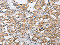The image on the left is immunohistochemistry of paraffin-embedded Human thyroid cancer tissue using CSB-PA936424(CENPO Antibody) at dilution 1/40, on the right is treated with fusion protein. (Original magnification: ×200)