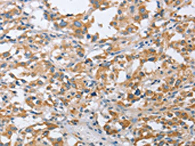 The image on the left is immunohistochemistry of paraffin-embedded Human thyroid cancer tissue using CSB-PA936424(CENPO Antibody) at dilution 1/40, on the right is treated with fusion protein. (Original magnification: ×200)
