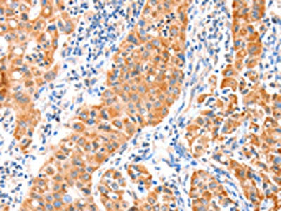 The image on the left is immunohistochemistry of paraffin-embedded Human lung cancer tissue using CSB-PA936526(VANGL1 Antibody) at dilution 1/20, on the right is treated with fusion protein. (Original magnification: ×200)
