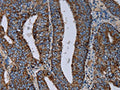 The image on the left is immunohistochemistry of paraffin-embedded Human colon cancer tissue using CSB-PA936910(NDUFS4 Antibody) at dilution 1/20, on the right is treated with fusion protein. (Original magnification: ×200)