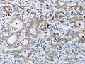 The image on the left is immunohistochemistry of paraffin-embedded Human gastic cancer tissue using CSB-PA937099(ABCB9 Antibody) at dilution 1/15, on the right is treated with synthetic peptide. (Original magnification: ×200)