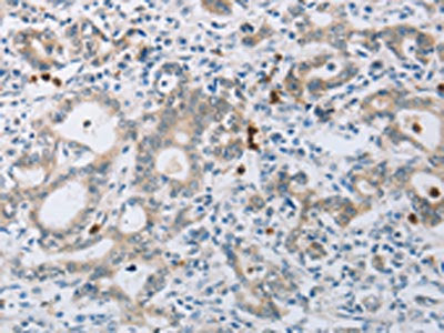 The image on the left is immunohistochemistry of paraffin-embedded Human gastic cancer tissue using CSB-PA937099(ABCB9 Antibody) at dilution 1/15, on the right is treated with synthetic peptide. (Original magnification: ×200)