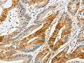 The image on the left is immunohistochemistry of paraffin-embedded Human colon cancer tissue using CSB-PA937183(ANAPC2 Antibody) at dilution 1/20, on the right is treated with fusion protein. (Original magnification: ×200)