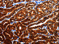 The image is immunohistochemistry of paraffin-embedded Human thyroid cancer tissue using CSB-PA937228(AK1 Antibody) at dilution 1/25. (Original magnification: ×200)