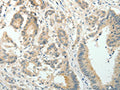 The image on the left is immunohistochemistry of paraffin-embedded Human colon cancer tissue using CSB-PA937428(SIRT3 Antibody) at dilution 1/30, on the right is treated with fusion protein. (Original magnification: ×200)