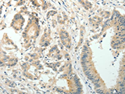 The image on the left is immunohistochemistry of paraffin-embedded Human colon cancer tissue using CSB-PA937428(SIRT3 Antibody) at dilution 1/30, on the right is treated with fusion protein. (Original magnification: ×200)