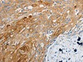 The image on the left is immunohistochemistry of paraffin-embedded Human cervical cancer tissue using CSB-PA937611(EDNRB Antibody) at dilution 1/30, on the right is treated with synthetic peptide. (Original magnification: ×200)