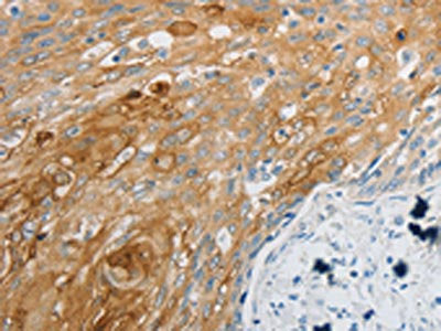 The image on the left is immunohistochemistry of paraffin-embedded Human cervical cancer tissue using CSB-PA937611(EDNRB Antibody) at dilution 1/30, on the right is treated with synthetic peptide. (Original magnification: ×200)