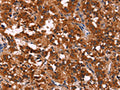The image on the left is immunohistochemistry of paraffin-embedded Human thyroid cancer tissue using CSB-PA937841(RPSA Antibody) at dilution 1/60, on the right is treated with fusion protein. (Original magnification: ×200)