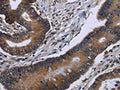 The image on the left is immunohistochemistry of paraffin-embedded Human colon cancer tissue using CSB-PA937919(ITGAE Antibody) at dilution 1/60, on the right is treated with fusion protein. (Original magnification: ×200)