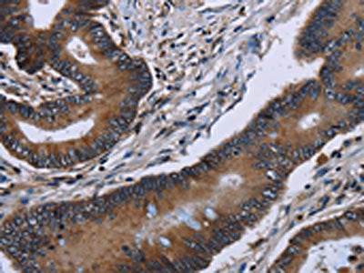 The image on the left is immunohistochemistry of paraffin-embedded Human colon cancer tissue using CSB-PA937919(ITGAE Antibody) at dilution 1/60, on the right is treated with fusion protein. (Original magnification: ×200)
