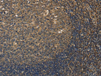 The image on the left is immunohistochemistry of paraffin-embedded Human tonsil tissue using CSB-PA938110(DDX19B Antibody) at dilution 1/20, on the right is treated with fusion protein. (Original magnification: ×200)