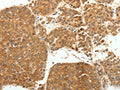 The image on the left is immunohistochemistry of paraffin-embedded Human liver cancer tissue using CSB-PA938450(SOCS3 Antibody) at dilution 1/20, on the right is treated with fusion protein. (Original magnification: X200)